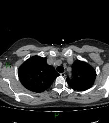 Aortic valve endocarditis (Radiopaedia 87209-103485 Axial non-contrast 24).jpg