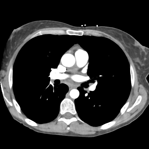 File:Aortic valve non-coronary cusp thrombus (Radiopaedia 55661-62189 B 24).png