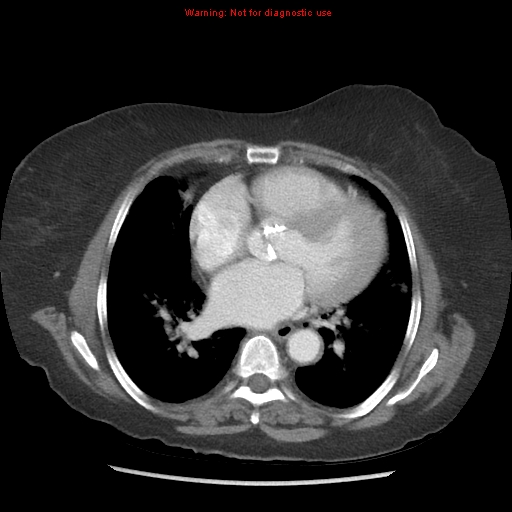 File:Aortic valve stenosis (Radiopaedia 14480-14423 C 9).jpg