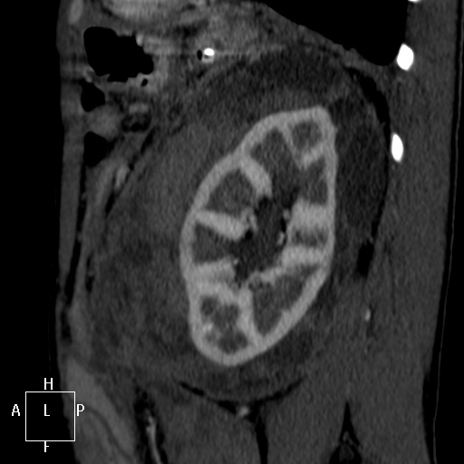 Aorto-left renal vein fistula (Radiopaedia 45534-49628 C 57).jpg