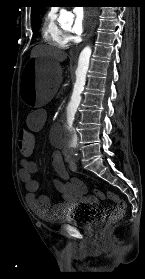 Aortoduodenal fistula (Radiopaedia 75286-86415 F 25).jpg