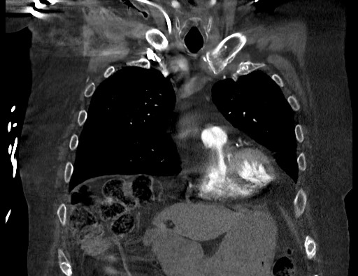Aortoesophageal fistula with endovascular repair (Radiopaedia 73781-84592 Coronal C+ CTPA 31).jpg