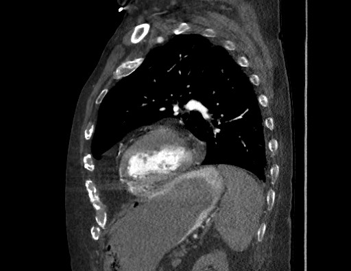 Aortoesophageal fistula with endovascular repair (Radiopaedia 73781-84592 Sagittal C+ CTPA 140).jpg