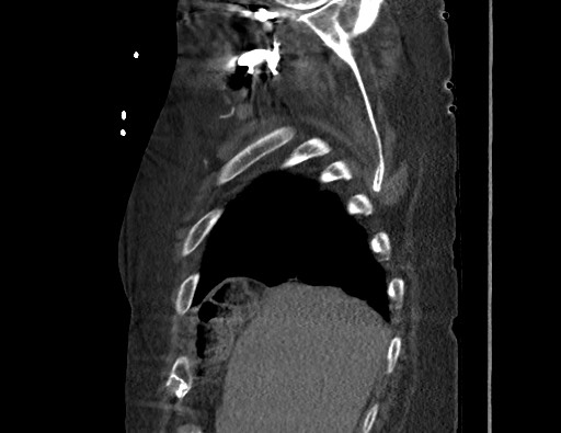 Aortoesophageal fistula with endovascular repair (Radiopaedia 73781-84592 Sagittal C+ CTPA 19).jpg