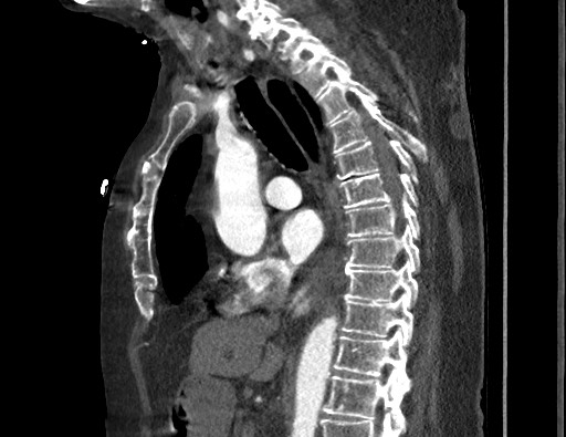 Aortoesophageal fistula with endovascular repair (Radiopaedia 73781-84592 Sagittal C+ CTPA 96).jpg
