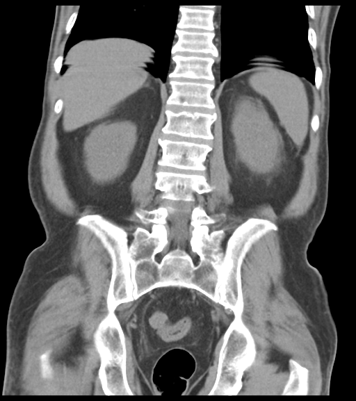 File:Appendiceal abscesses (Radiopaedia 50999-56542 Coronal non-contrast 42).png