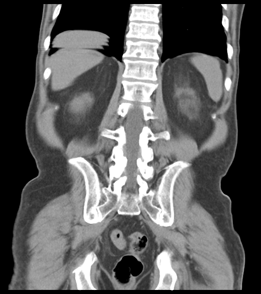 File:Appendiceal abscesses (Radiopaedia 50999-56542 Coronal non-contrast 44).png