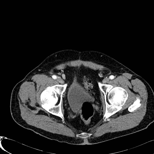 File:Appendiceal adenocarcinoma complicated by retroperitoneal abscess (Radiopaedia 58007-65039 B 133).jpg