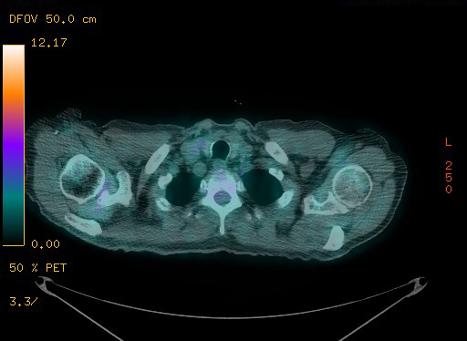 File:Appendiceal adenocarcinoma complicated by retroperitoneal abscess (Radiopaedia 58007-65041 Axial PET-CT 32).jpg