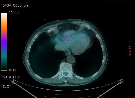 Appendiceal adenocarcinoma complicated by retroperitoneal abscess (Radiopaedia 58007-65041 Axial PET-CT 96).jpg