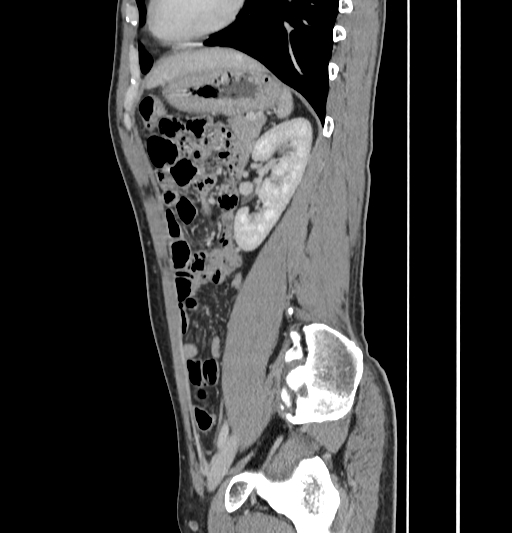 Appendiceal mucinous adenocarcinoma (Radiopaedia 66605-75922 C 47).jpg