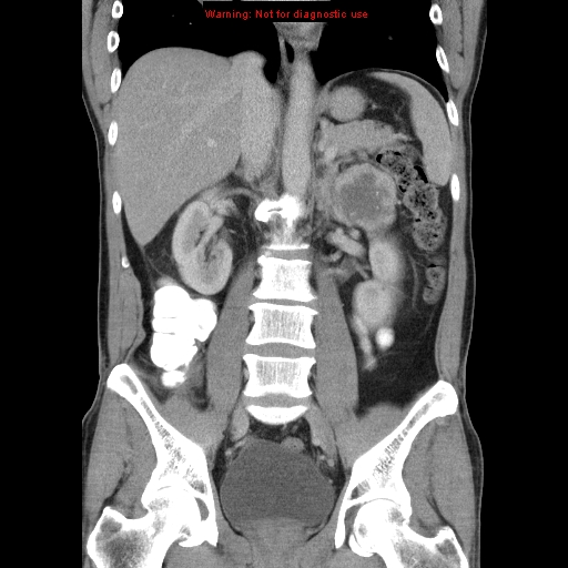 File:Appendicitis and renal cell carcinoma (Radiopaedia 17063-16760 B 18).jpg