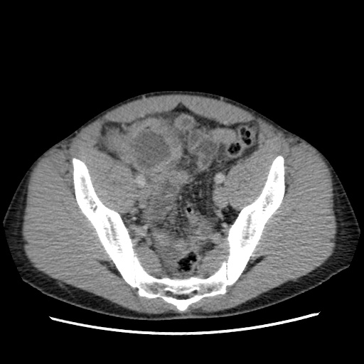 File:Appendicitis complicated by post-operative collection (Radiopaedia 35595-37114 A 70).jpg
