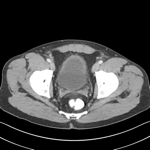 Appendicitis with cecal bar sign (Radiopaedia 31878-32830 B 74).jpg