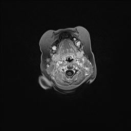 Aqueductal stenosis (Radiopaedia 73974-84802 Axial T1 C+ 19).jpg