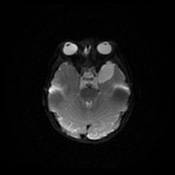 Arachnoid cyst - middle cranial fossa (Radiopaedia 86780-102938 Axial DWI 49).jpg