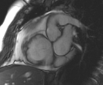 Arrhythmogenic right ventricular cardiomyopathy (Radiopaedia 69431-79307 Short axis cine 210).jpg