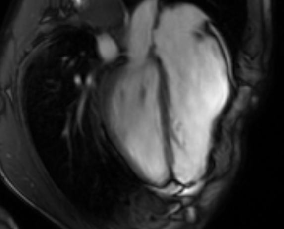 Arrhythmogenic right ventricular cardiomyopathy (Radiopaedia 69564-79464 4ch cine 97).jpg