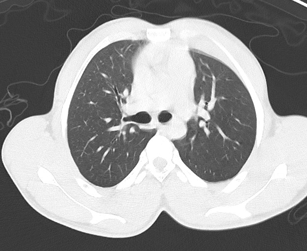Arrow injury to the chest (Radiopaedia 75223-86321 Axial lung window 24).jpg