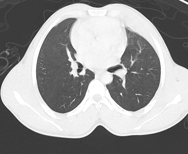 Arrow injury to the chest (Radiopaedia 75223-86321 Axial lung window 37).jpg