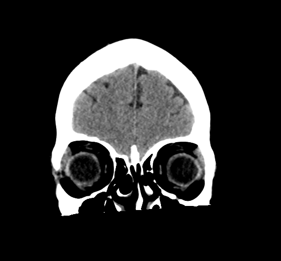 File:Arteriovenous malformation (cerebral) (Radiopaedia 40070-42579 Coronal non-contrast 7).png