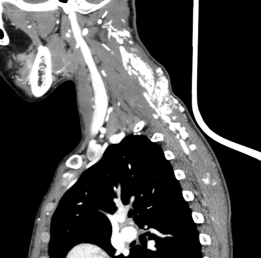 Arteriovenous malformation of the neck (Radiopaedia 53935-60062 C 32).jpg