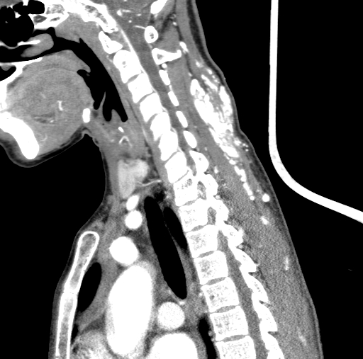 File:Arteriovenous malformation of the neck (Radiopaedia 53935-60062 C 59).jpg