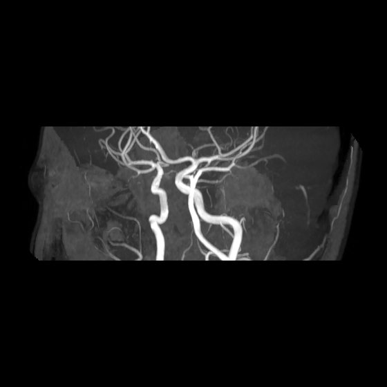 File:Artery of Percheron infarct (Radiopaedia 40966-43676 G 43).jpg