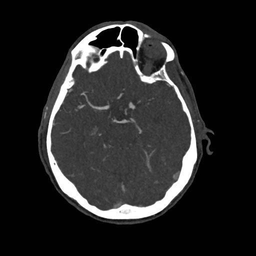 Artery of Percheron infarct (Radiopaedia 48088-52894 A 128).jpg