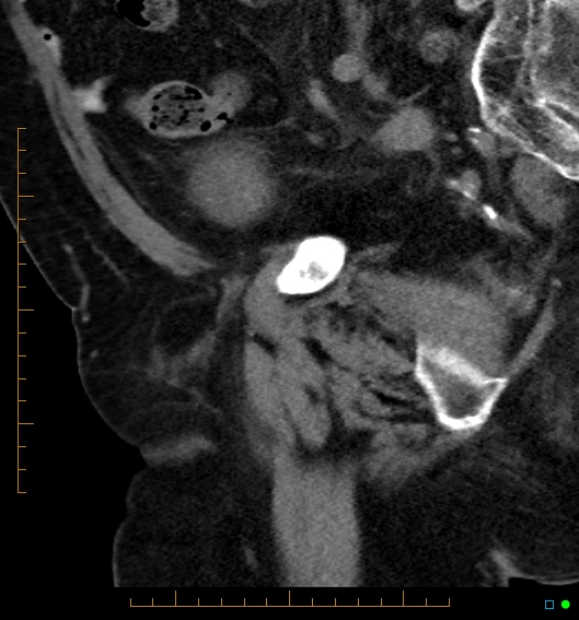 File:Artificial urethral sphincter (Radiopaedia 46937-51464 Sagittal C+ delayed 28).jpg