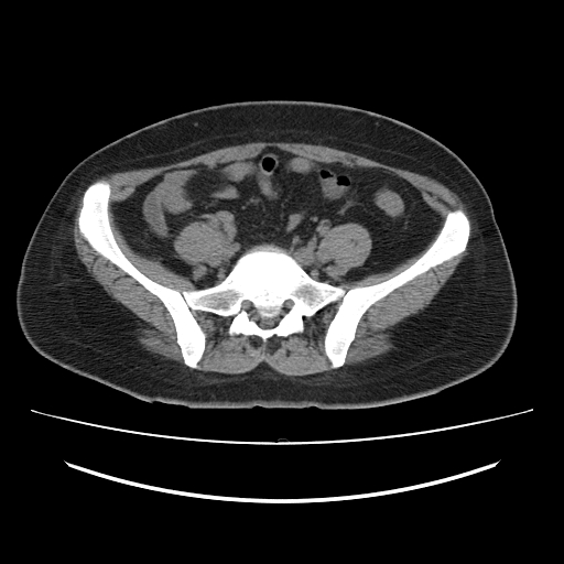 File:Ascending retrocecal appendicitis with liver abscesses (Radiopaedia 60066-67615 Axial non-contrast 62).jpg