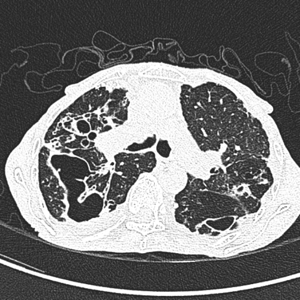 File:Aspergilloma- with Monod sign (Radiopaedia 44737-48532 Axial lung window 102).jpg