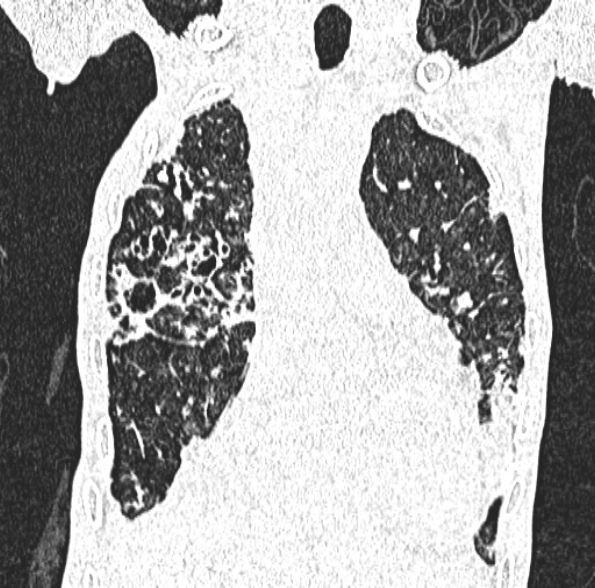 Aspergilloma- with Monod sign (Radiopaedia 44737-48532 Coronal lung window 187).jpg