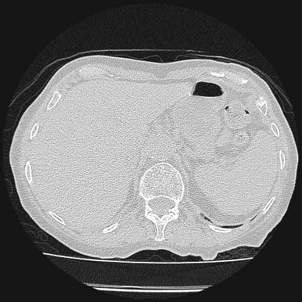 Aspergilloma (Radiopaedia 24458-24763 Axial lung window 68).jpg