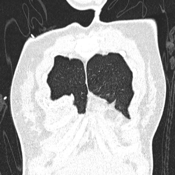 File:Aspergilloma (Radiopaedia 26223-26347 Coronal lung window 7).jpg