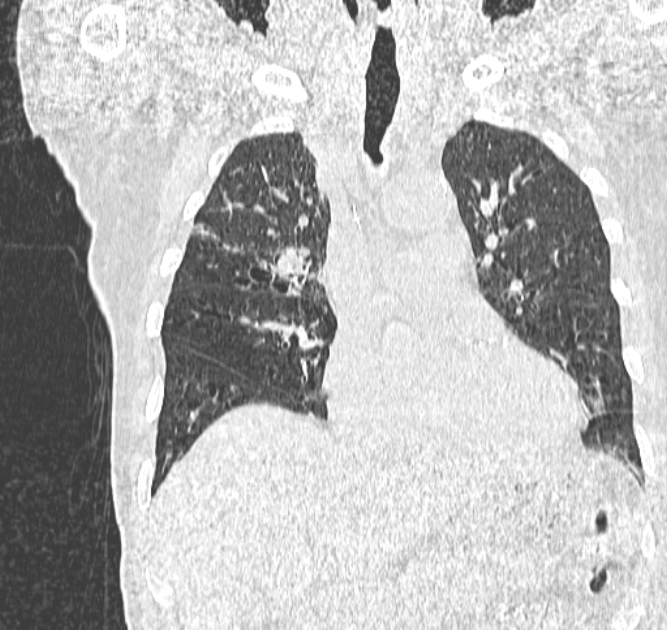 Aspergilloma (Radiopaedia 44592-48327 Coronal lung window 49).jpg