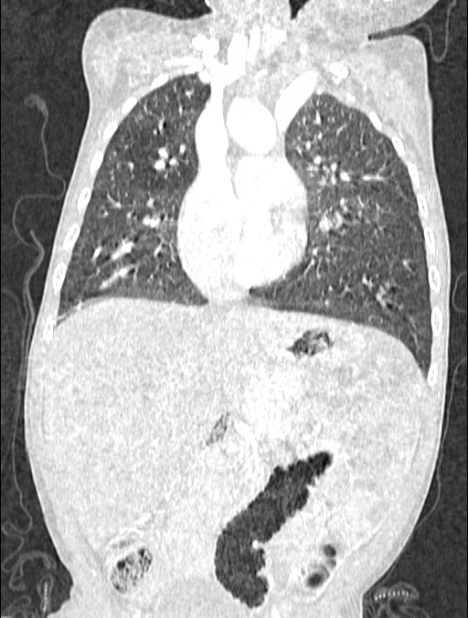 Asplenia syndrome (Radiopaedia 73083-83792 Coronal lung window 62).jpg