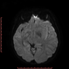 Astroblastoma (Radiopaedia 74287-85162 Axial DWI 45).jpg