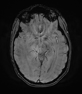 File:Astrocytoma, IDH-mutant - grade 3 (Radiopaedia 50046-55341 Axial 276).png