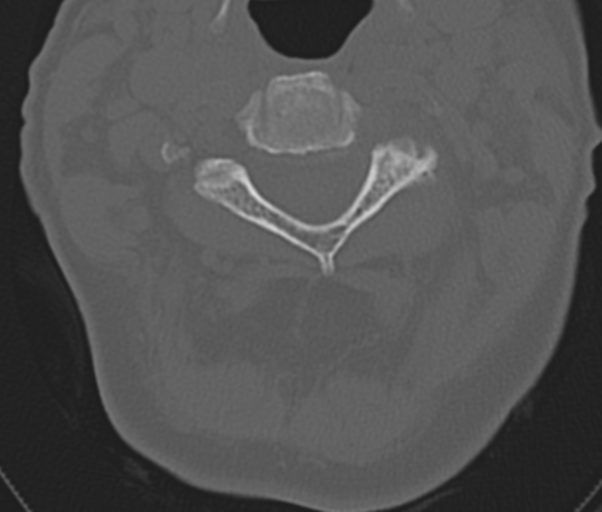 Atlanto-axial subluxation (Radiopaedia 36610-38176 Axial bone window 21).png