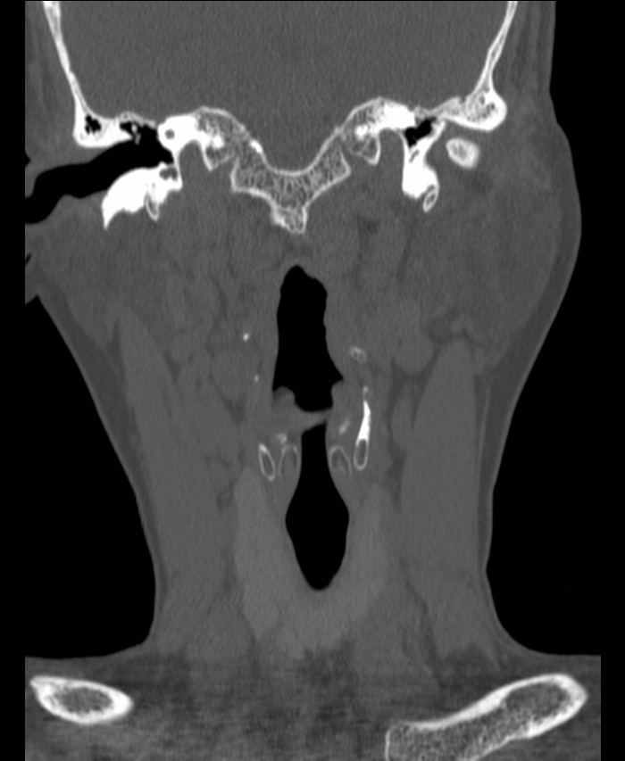 Atlanto-occipital assimilation with basilar invagination (Radiopaedia 70122-80188 Coronal bone window 32).jpg
