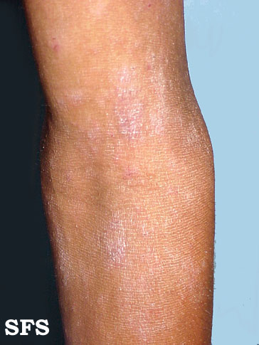 Atopic Dermatitis (Dermatology Atlas 15).jpg