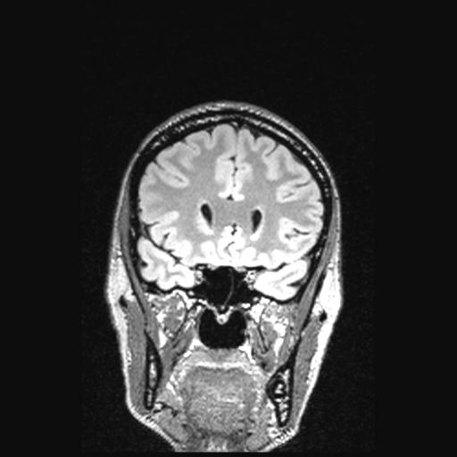 Atretic encephalocoele with inferior vermis hypoplasia (Radiopaedia 30443-31108 Coronal FLAIR 128).jpg