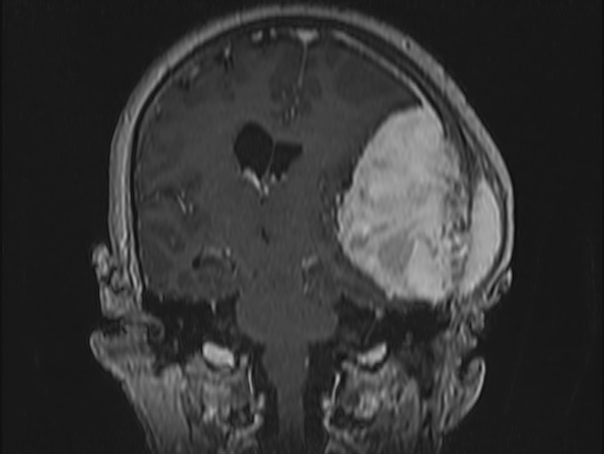 Atypical meningioma (Radiopaedia 62985-71406 Coronal T1 C+ 66).jpg
