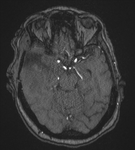 Atypical meningioma (WHO Grade II) (Radiopaedia 54742-60981 Axial MRA 37).png