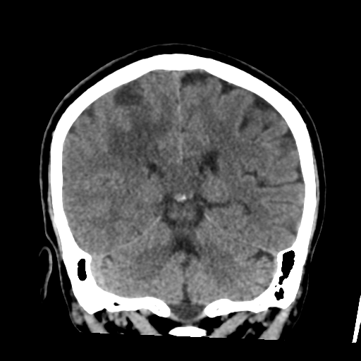 Atypical meningioma (WHO grade II) with osseous invasion (Radiopaedia 53654-59715 Coronal non-contrast 42).png