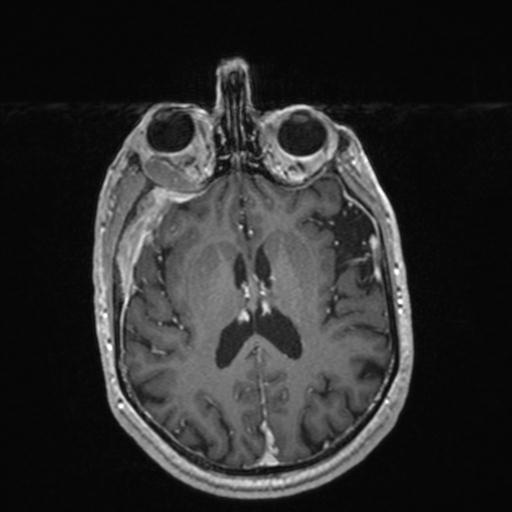 Atypical meningioma (grade II) - en plaque (Radiopaedia 29633-30147 Axial T1 C+ 108).jpg