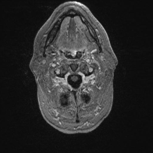 Atypical meningioma (grade II) - en plaque (Radiopaedia 29633-30147 Axial T1 C+ 14).jpg