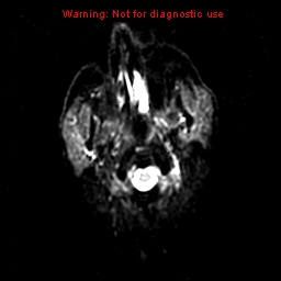 File:Atypical meningioma - grade II (Radiopaedia 13303-13305 Axial DWI 22).jpg