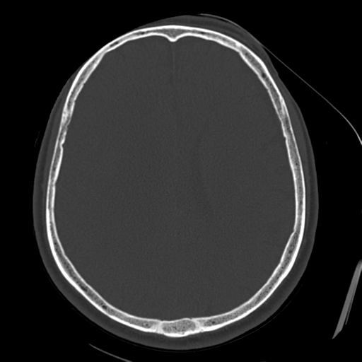 Atypical meningioma with skull invasion (Radiopaedia 34357-35649 Axial bone window 51).png